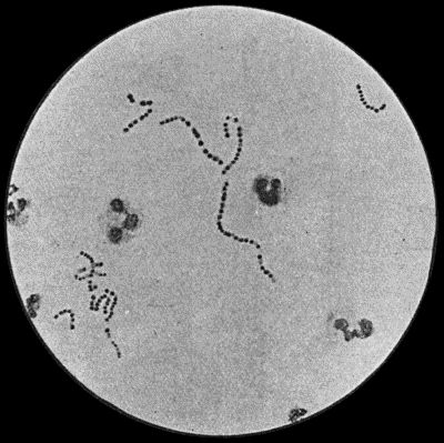 Fig. 3.&mdash;Streptococci in Pus from an acute abscess in subcutaneous tissue. &times; 1000 diam. Gram's stain.