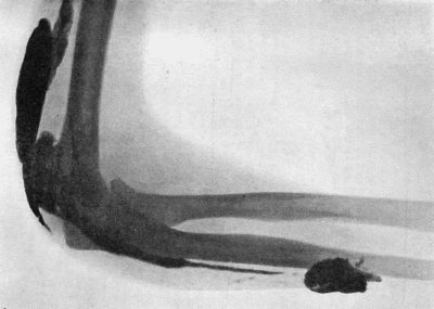 Fig. 35.&mdash;Tuberculous Sinus injected through its opening in the forearm with bismuth paste. (Mr. Pirie Watson's case&mdash;Radiogram by Dr. Hope Fowler.)