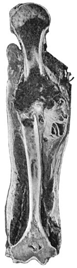 Fig. 53.&mdash;Myeloma of Shaft of Humerus, causing pathological fracture. (Mr. J.W. Struthers' case.)  (The unusual site of the tumour is to be noted.)