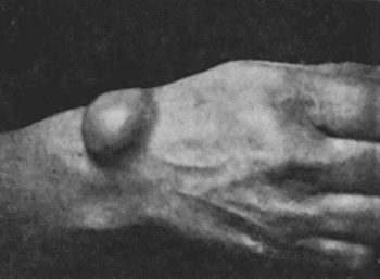 Fig. 60.&mdash;Carpal Ganglion in a woman &aelig;t.&nbsp;25.