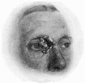 Fig. 102.&mdash;Rodent Cancer of Inner Canthus.