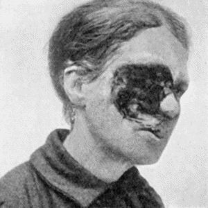 Fig. 103.&mdash;Rodent Cancer of fifteen years' duration, which has destroyed the contents of the Orbit. (Sir Montagu Cotterill's case)