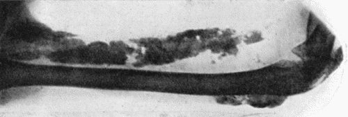 Fig. 111.&mdash;Calcification and Ossification in Biceps and Triceps. (From a radiogram lent by Dr. C.A. Adair Dighton.)