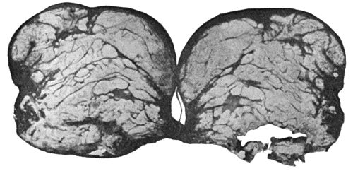 Fig. 114.&mdash;Section through Bursa over external malleolus, showing deposit of urate of soda. (Cf. Fig. 117.)