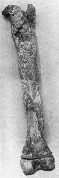 Fig. 118.&mdash;Shaft of Femur after Acute Osteomyelitis. The shaft has undergone extensive necrosis, and a shell of new bone has been formed by the periosteum.