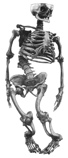 Fig. 133.&mdash;Skeleton of Rickety Dwarf, known as "Bowed Joseph," leader of the Meal Riots in Edinburgh, who died in 1780. (Anatomical Museum, University of Edinburgh.)