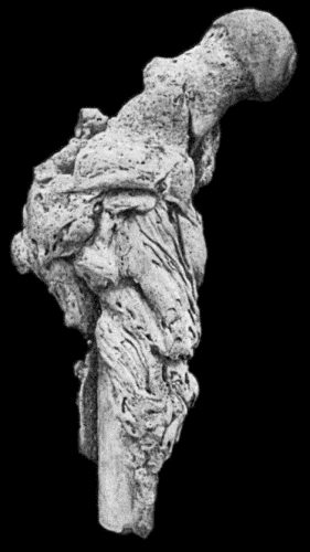 Fig. 150.&mdash;Osseous Shell of Osteo-Sarcoma of Upper Third of Femur, after maceration.