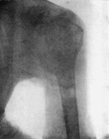 Fig. 152.&mdash;Radiogram of Chondro-Sarcoma of Upper End of Humerus in a woman &aelig;t.&nbsp;29.