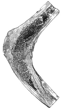 Fig. 154.&mdash;Osseous Ankylosis of Femur and Tibia in position of flexion.