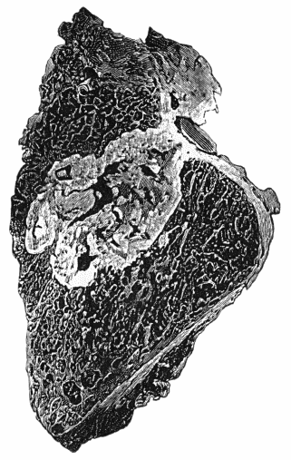 Fig. 156.&mdash;Section of Upper End of Fibula, showing caseating focus in marrow, erupting on articular surface and infecting joint.