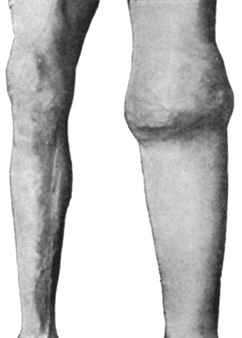 Fig. 163.&mdash;Charcot's Disease of Left Knee. The joint is distended with fluid and the whole limb is œdematous.