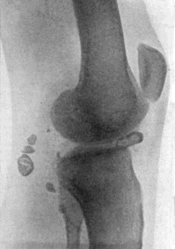 Fig. 166.&mdash;Radiogram of Multiple Loose Bodies in Knee-joint and Semi-membranosus Bursa in a man &aelig;t.&nbsp;38. (Mr. J.W. Dowden's case.)