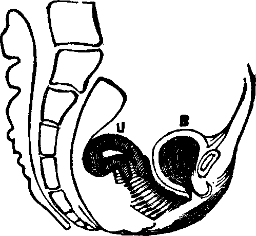 Illustration:
Fig. 10. Flexion, u, Uterus, B, Bladder.