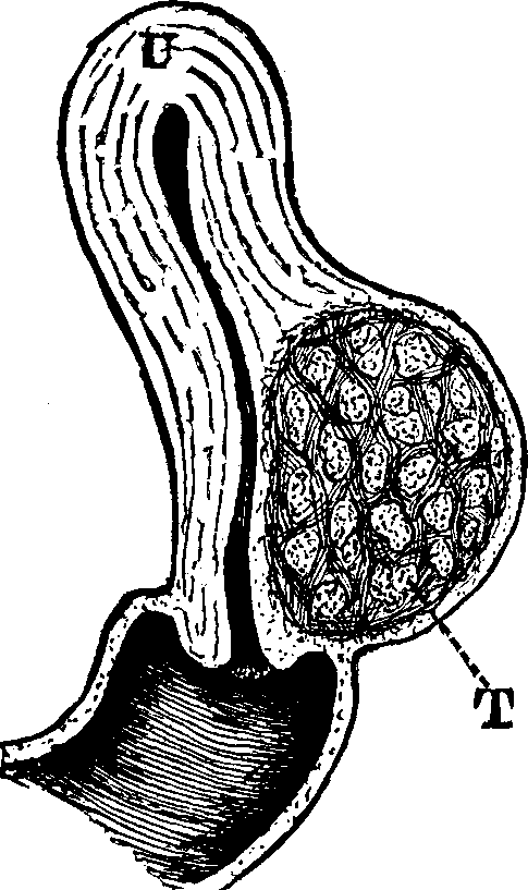 Illustration:
Fig. 19. U, Uterus. T, Tumor.