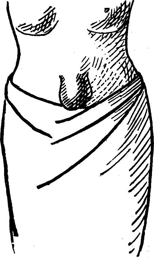 Illustration:
Fig. 3.  UMBILICAL HERNIA.