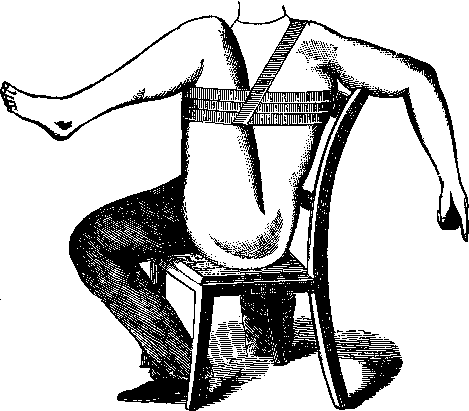 Illustration:
Mode of employing flexion for the arrest of hemorrhage from a wound located
between the thigh and knee.