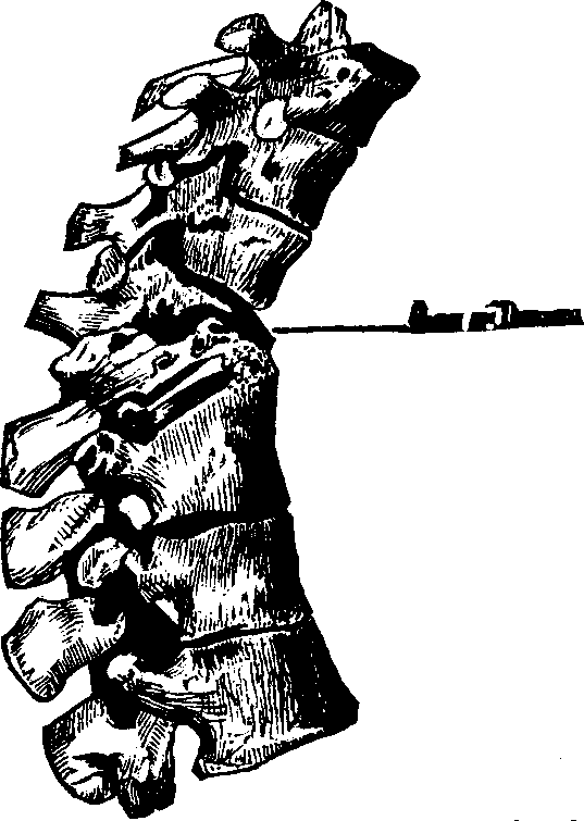 Illustration:
Fig. 1.  The above portion of the spinal column shows the manner of the
breaking down of the vertebr&aelig; from caries, and the absorption of
their bony structure.