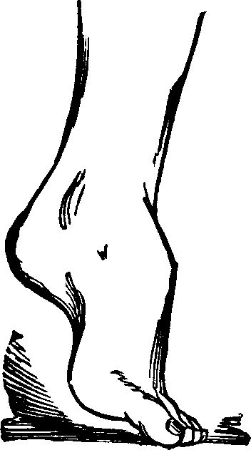 Illustration:
Fig. 10. Talipes Equinus.