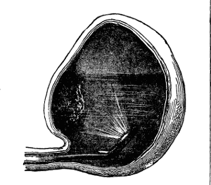 Traveling up urethra, scope views
tumor from the inside of the bladder.