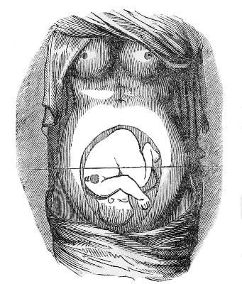 Fœtus
in the next most frequent position